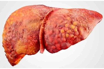 درمان سریع کبد چرب با چند میوه