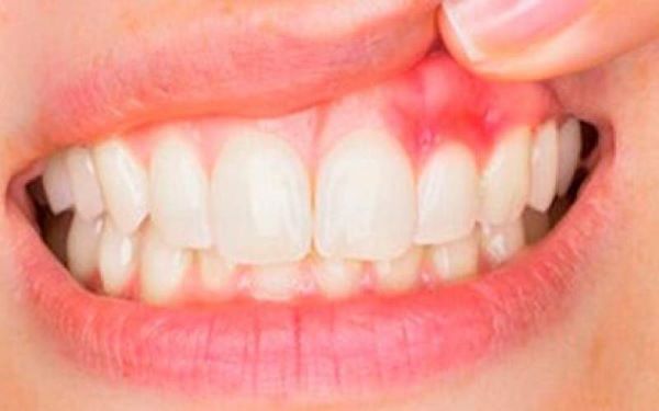 التهاب لثه را چگونه درمان کنیم؟